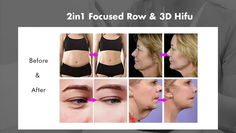 advanced 2 in 1 360 focused beauty face ultrasound hifu machine