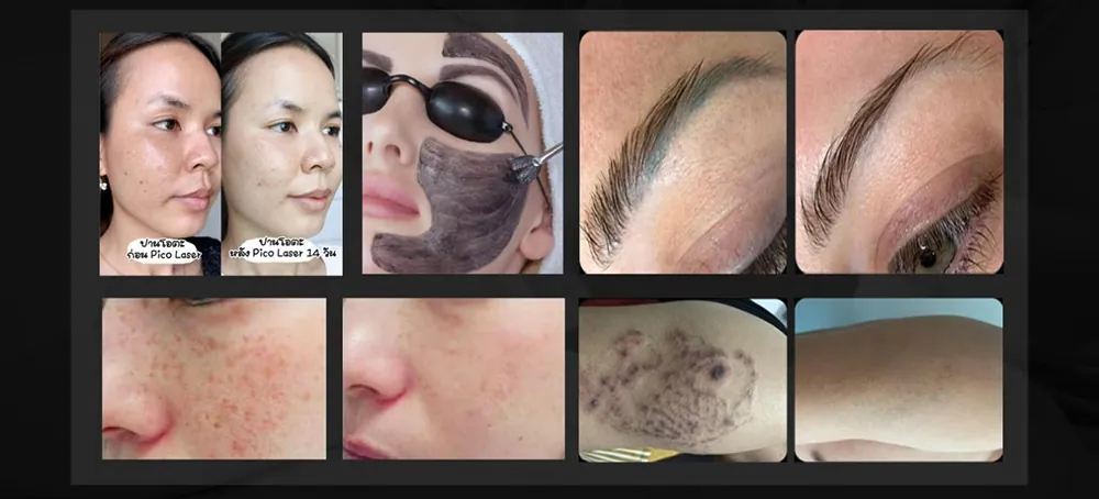 portable q switched nd: yag laser tattoo removal & carbon peeling machine