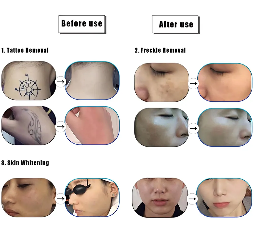 professional picosecond q switch nd: yag laser tattoo removal machine