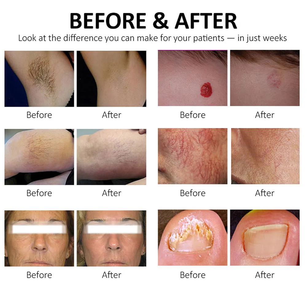 best medical 755nm alexandrite & 1064nm long pulse nd:yag laser hair removal machine