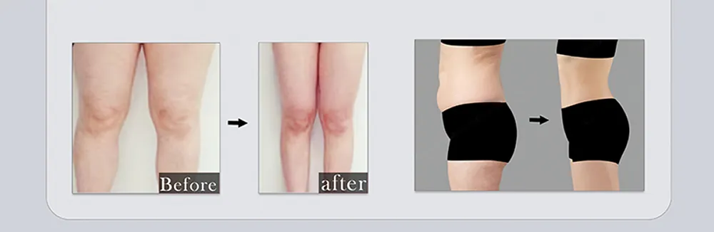 advanced 980nm + 1470nm diode laser endolift machine for lipolysis & surgery