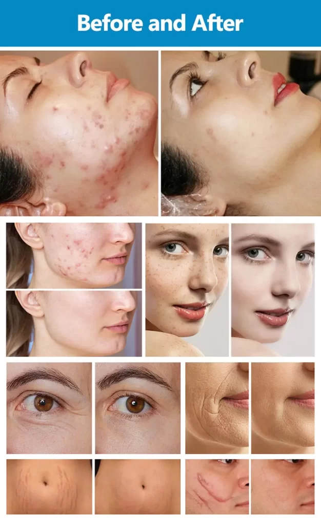 professional 60w co2 fractional laser machine for skin resurfacing & intimate care