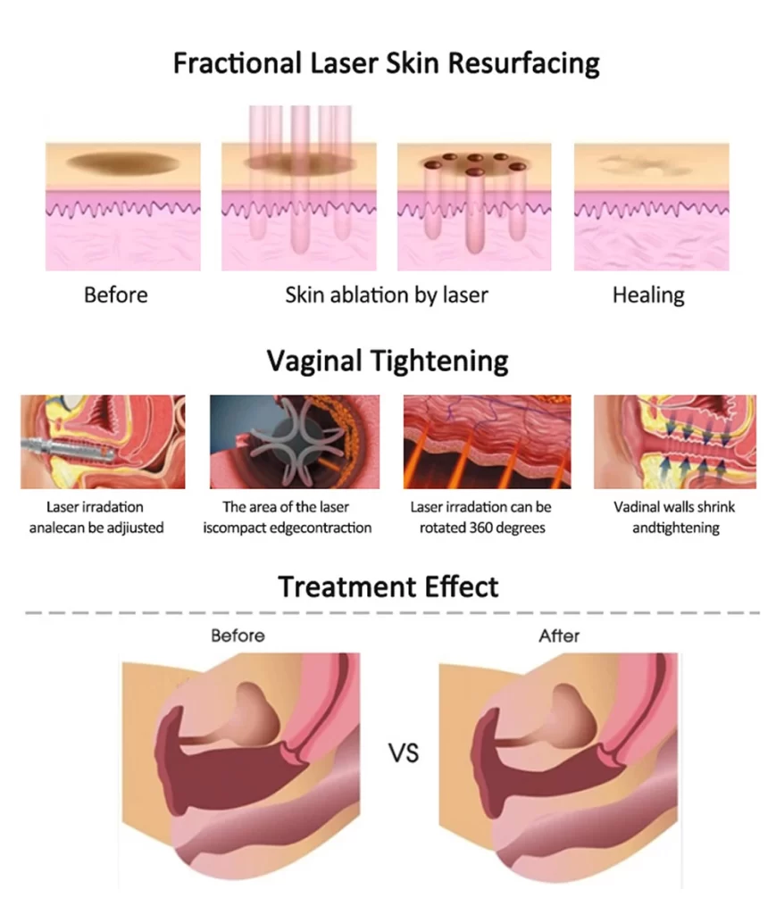 professional 60w co2 fractional laser machine for skin resurfacing & intimate care-6
