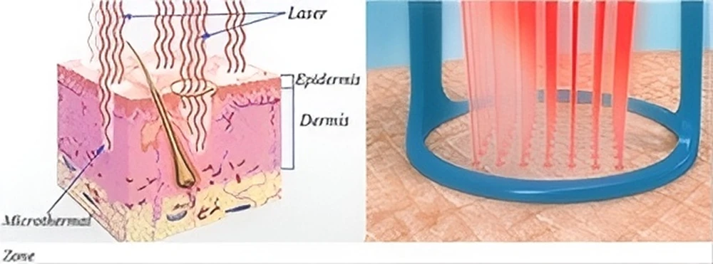 professional 60w co2 fractional laser machine for skin resurfacing & intimate care-7