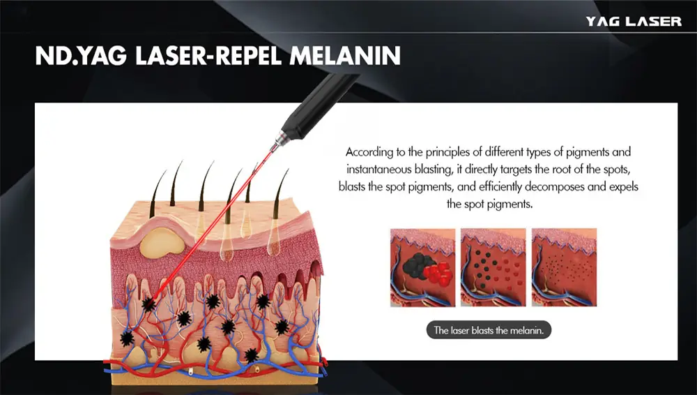 professional 2000w nd:yag picosecond laser machine for tattoo removal & pigmentation