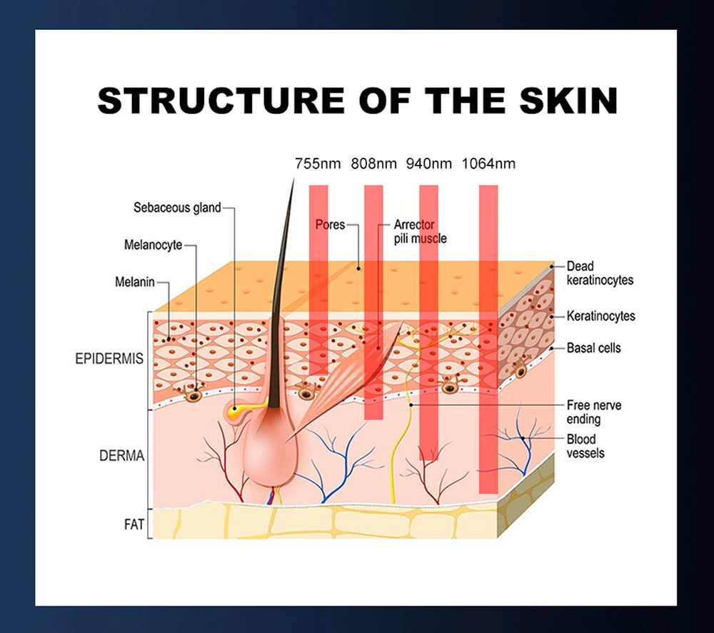 advanced 2000w 4 wavelength diode laser hair removal machine (755nm/808nm/940nm/1064nm)