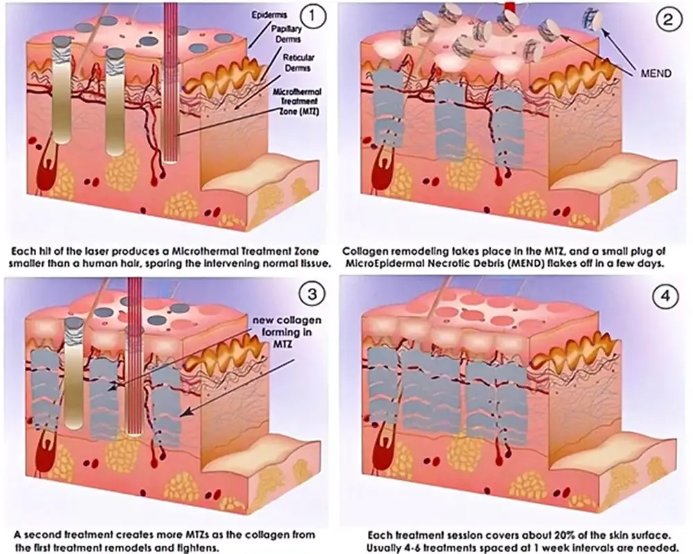 advanced portable rf fractional co2 laser machine for skin resurfacing & vaginal tightening