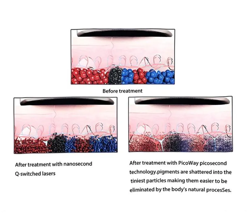 professional picosecond q switch nd: yag laser tattoo removal machine