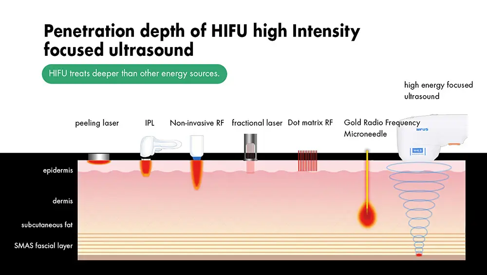 advanced 2 in 1 360 focused beauty face ultrasound hifu machine