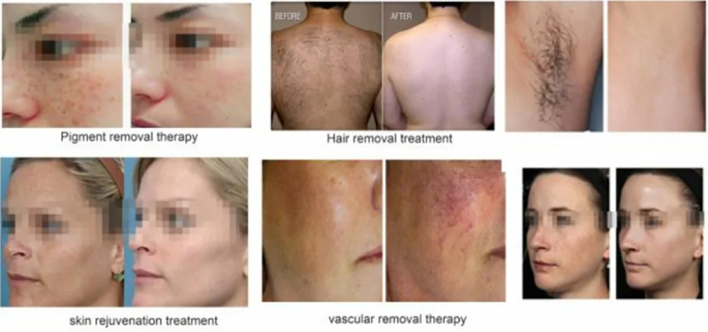 high efficiency portable opt ipl hair removal beauty machine