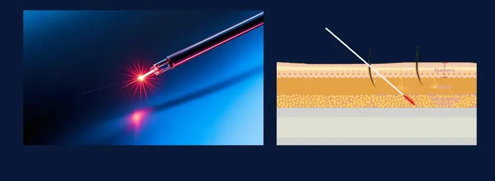 advanced 980nm + 1470nm diode laser endolift machine for lipolysis & surgery