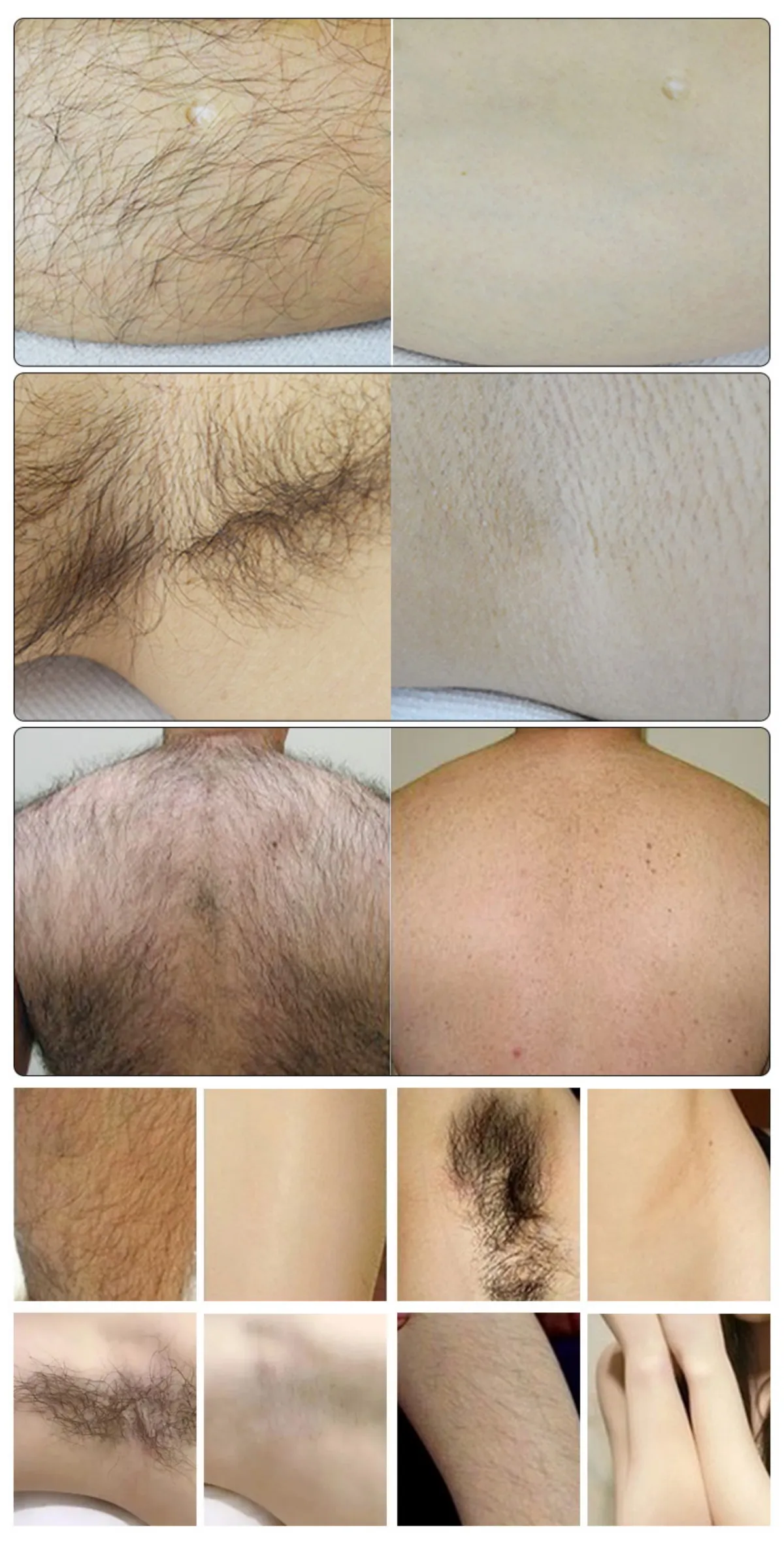 professional 2 in 1 ipl & q switch laser machine for hair & tattoo removal