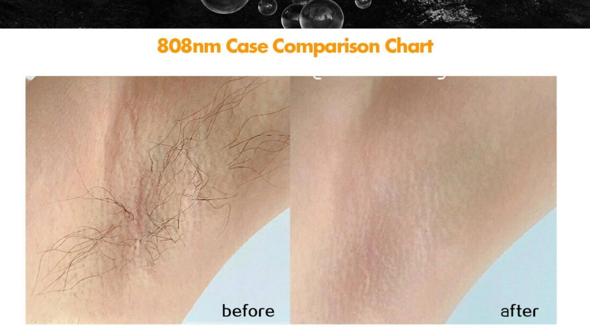 professional 1200w 808nm diode laser hair removal machine