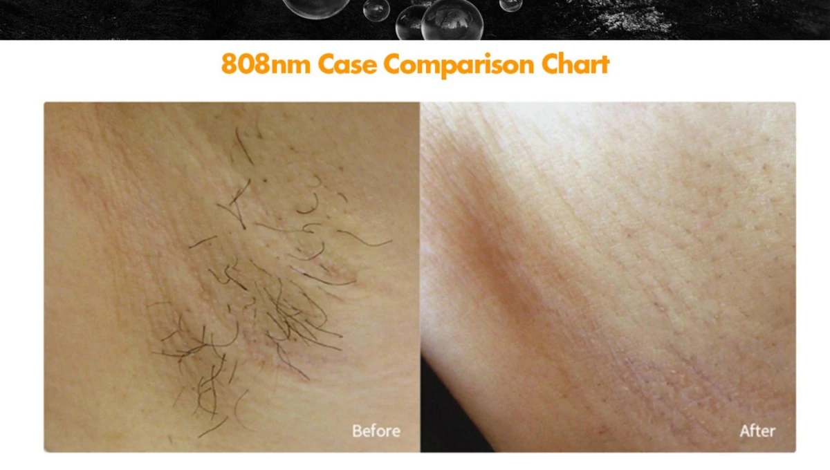 professional 1200w 808nm diode laser hair removal machine