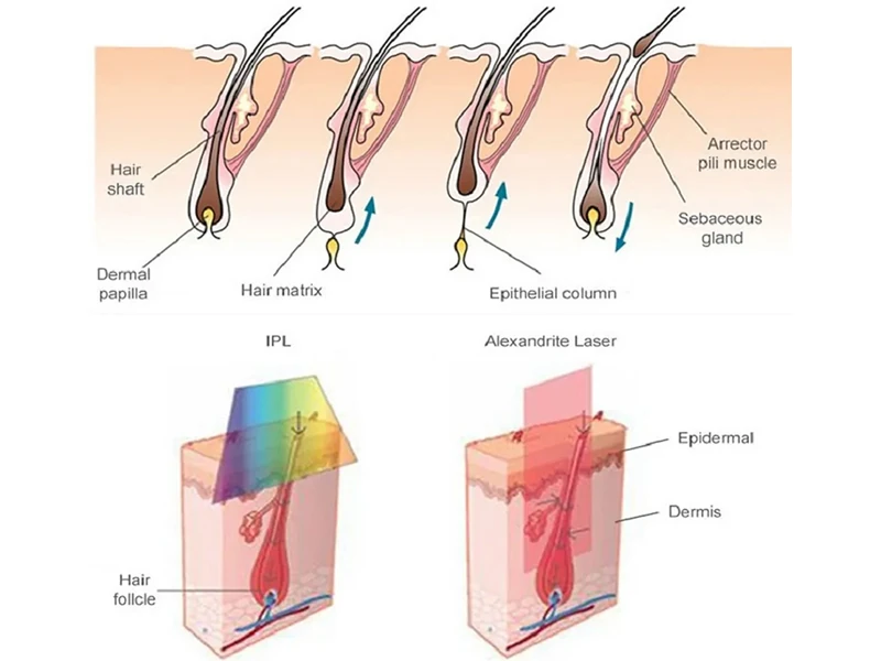 Diagram showing hair follicle structure and comparison between IPL and 755nm Alexandrite laser hair removal penetration depth and mechanism