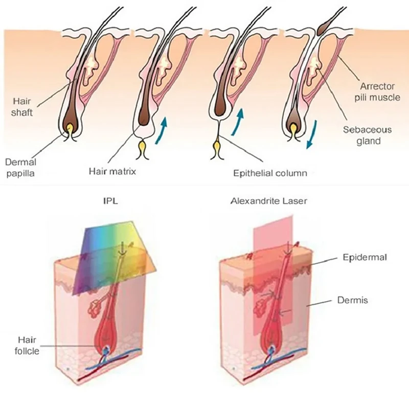 alexandrite vs ipl hair removal follicle structure diagram