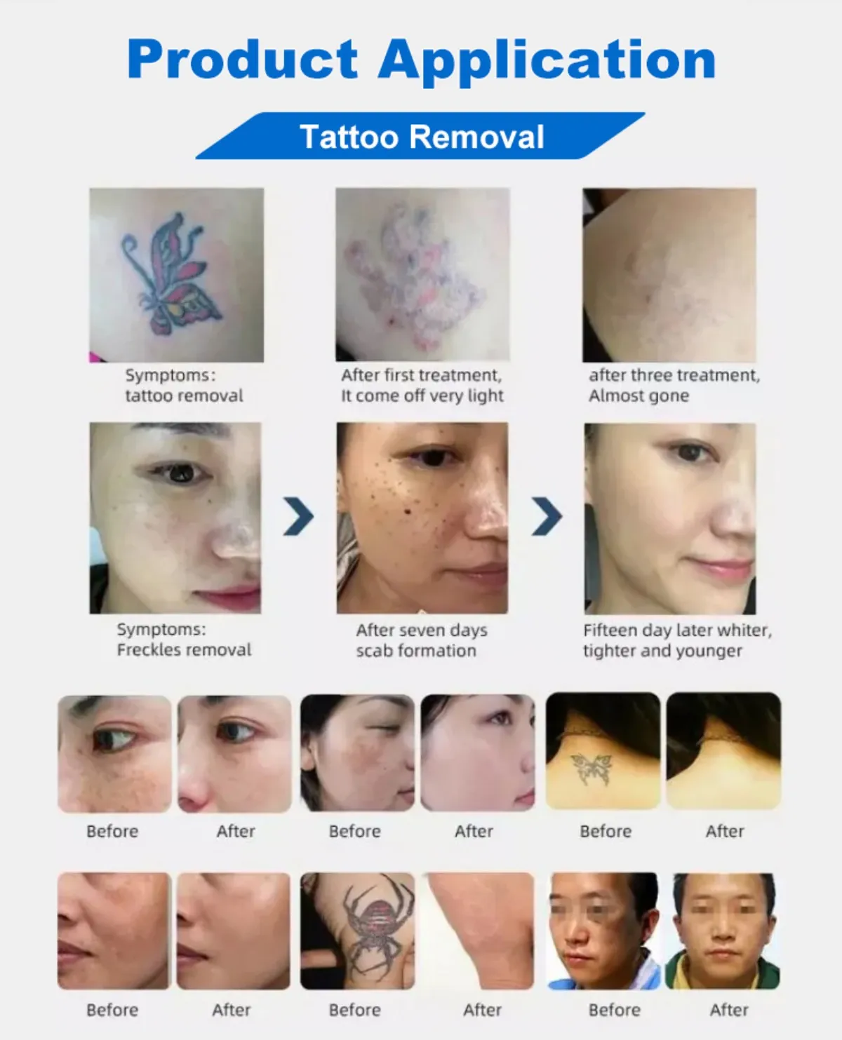 desktop 2000w picosecond laser tattoo removal machine (unlimited shots)